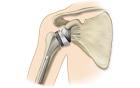 Shoulder replacement surgery cost in India