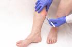 Unraveling the Genetic Mysteries of Varicose Veins: What Science Reveals