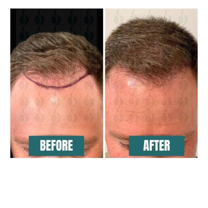 Sierra Robotic Hair Restoration Institute