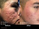 Acne scar treatment Irvine Irvine, California | OC MedDerm | Irvine skin