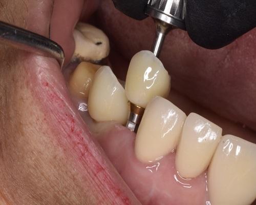 Bring back your true smile with our treatment of root canal in Tijuana