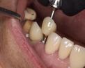 Bring back your true smile with our treatment of root canal in Tijuana