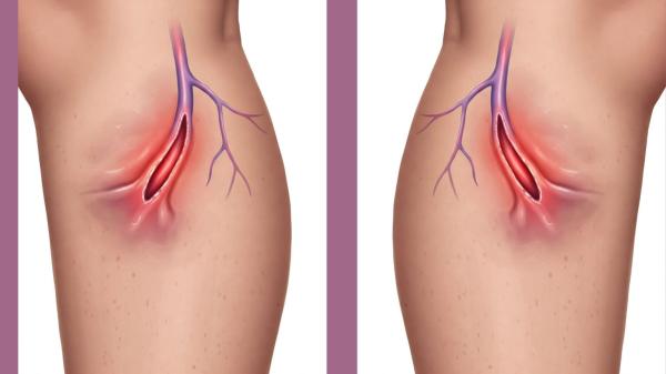Can You Die from a Burst Varicose Vein: Myths vs. Facts?
