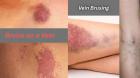 When Should You Worry About a Bruise on a Vein?