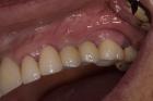 Dental implants Tijuana offers natural-looking and durable teeth replacements